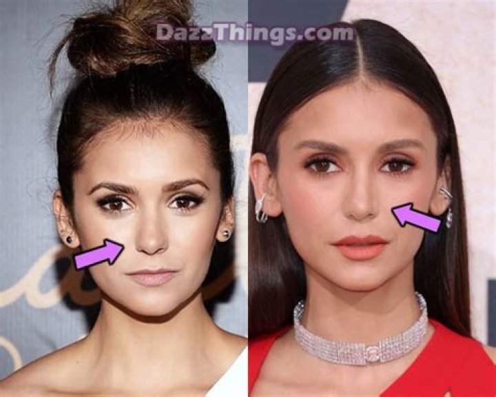 
Did Nina Dobrev Get Plastic Surgery? Who is Nina Dobrev? Nina Dobrev’s Net Worth 
