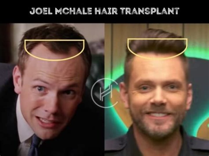 Has Joel Mchale Done Hair Transplant? Hair Loss Problems And Surgeries Facts About The Actor To Know