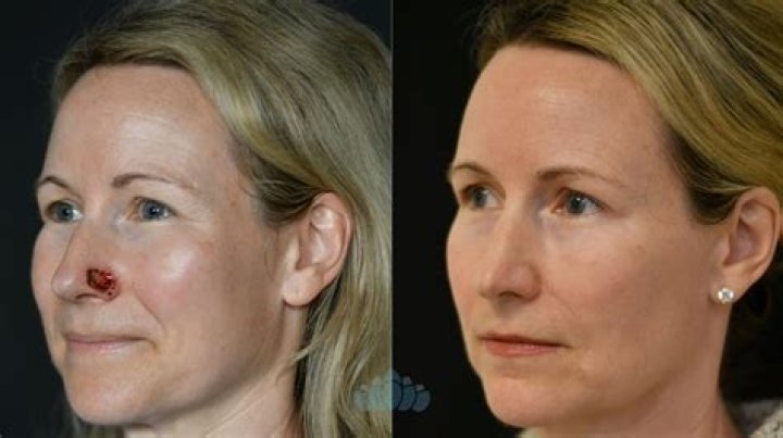 
Kathy Sabine Skin Cancer – Did She Get A Face Surgery? Details About The Journalist 