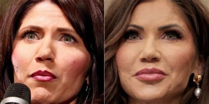 Kristi Noem Plastic Surgery- Before & After Pictures Depicts A Clear Difference