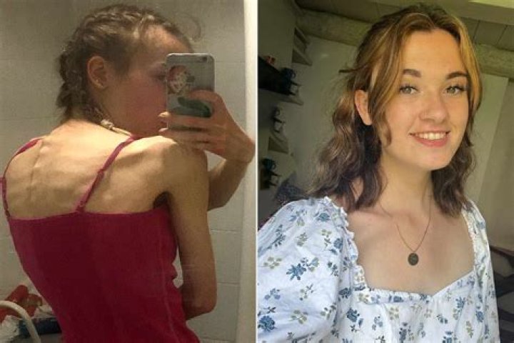 
Lani Pallister’s Health Has Fans Worried After Anorexia -What’s Happened To Her? 