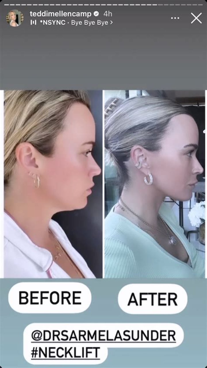 Teddi Mellencamp’s Before And After Necklift Pics Show Why She Hated The Surgery