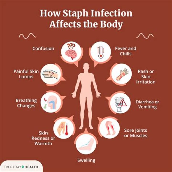 What ailment does Dr. Ed Hindson suffer from? Update on Staph Infection and Health