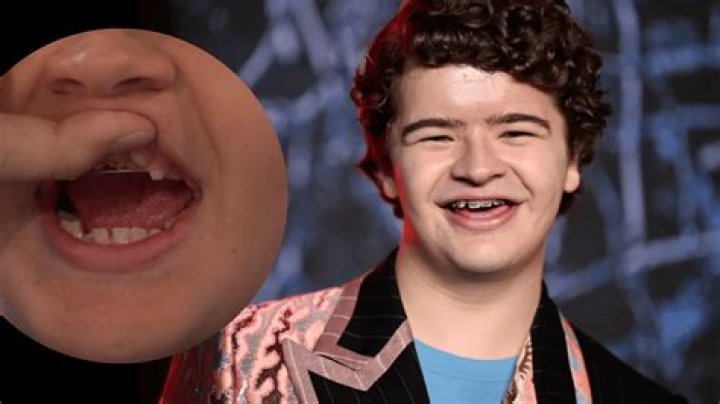 
What Happened To Gaten Matarazzo Shoulder And What Condition Does He Have? 
