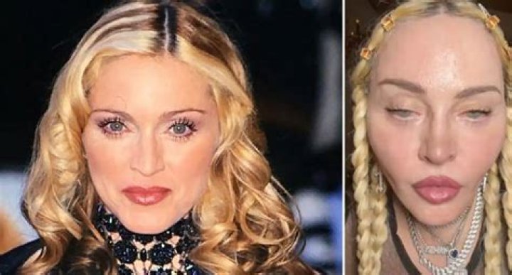 
What Happened To Madonna’s Face? The Queen Of Pop’s Plastic Surgery Details 